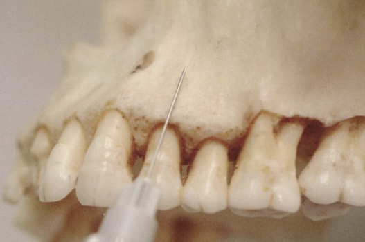 <p>What is the supraperiosteal injection?</p>