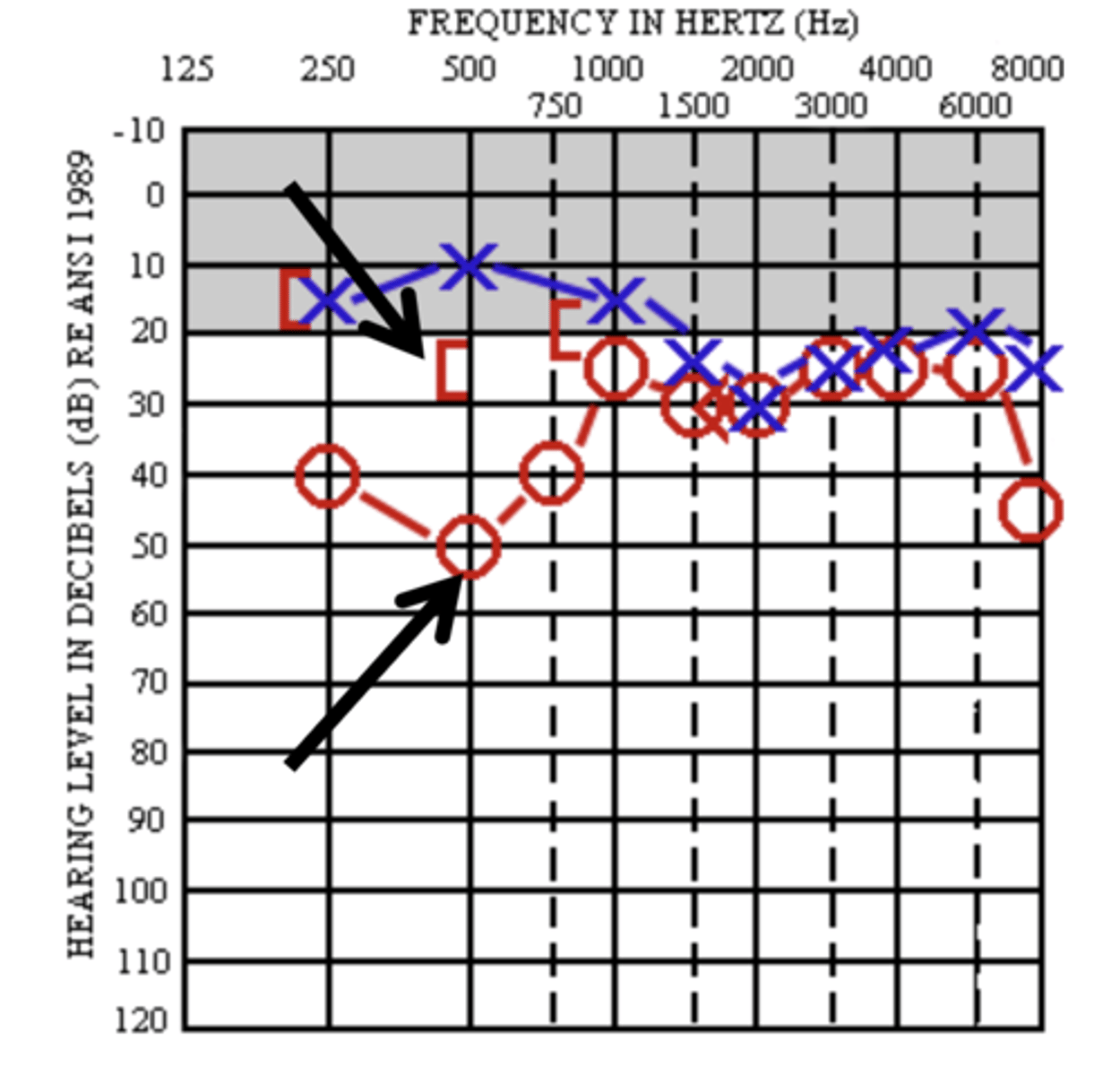 <p>unmasked AC - masked BC</p><p>practice ex:</p><p>- AC threshold at 500 hz = 50</p><p>- BC threshold at 500 hz = 25</p><p>- what is the difference between AC and BC = 25</p>