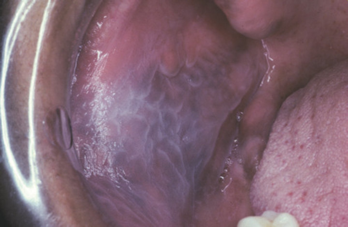 <p>bilateral milky white buccal mucosa </p><p>• disappears when stretched</p><p>• Population: African Americans</p>
