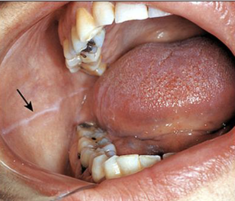 <p>“white” line that extends anteroposteriorly on the buccal mucosa along the occlusal plane, bilaterally</p>