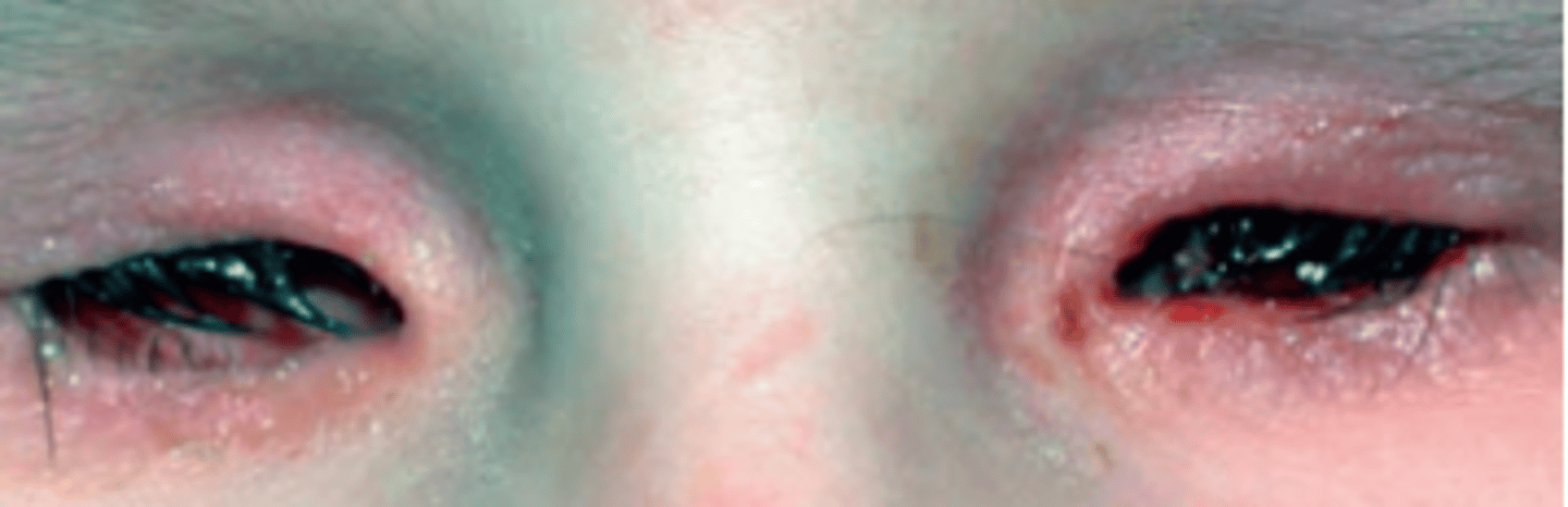 <p>a rare, complete failure of optic vesicle development occurring week 1-3 of embryological development. Can result in the disruption of development of other ocular structures including the orbit, lacrimal gland, lids, etc.</p>