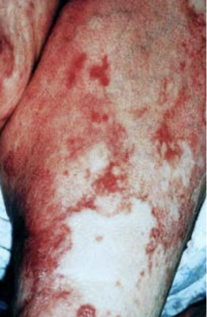 <p>tumor of pancreatic alpha cells associated with diabetes, dermatitis, deep vein thrombosis, depression, declining weight; large tumors and usually localized or have liver mets</p>
