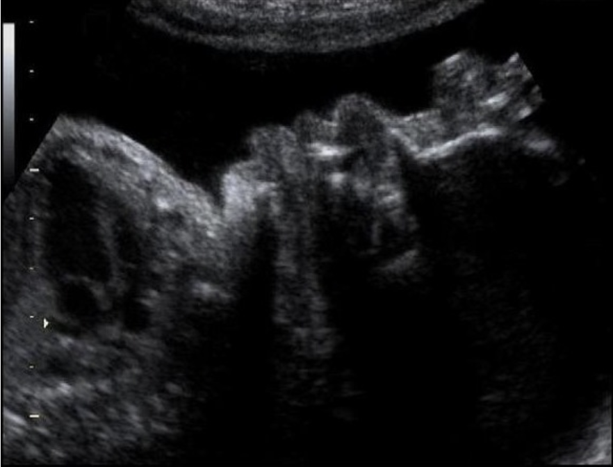 <p>which facial anomaly is commonly assoc w/beckwith wiedemann syndrome</p><p>a) frontal bossing</p><p>b) proboscis</p><p>c) macroglossia</p><p>d) midface hypoplasia </p>