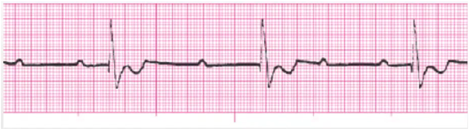 <p>pace maker</p><p>monitor EKG post-MI</p><p>limit activity, 02</p><p>(inferior/anterior MI)</p><p>AV dissociation, Ps and QRS have no association</p>
