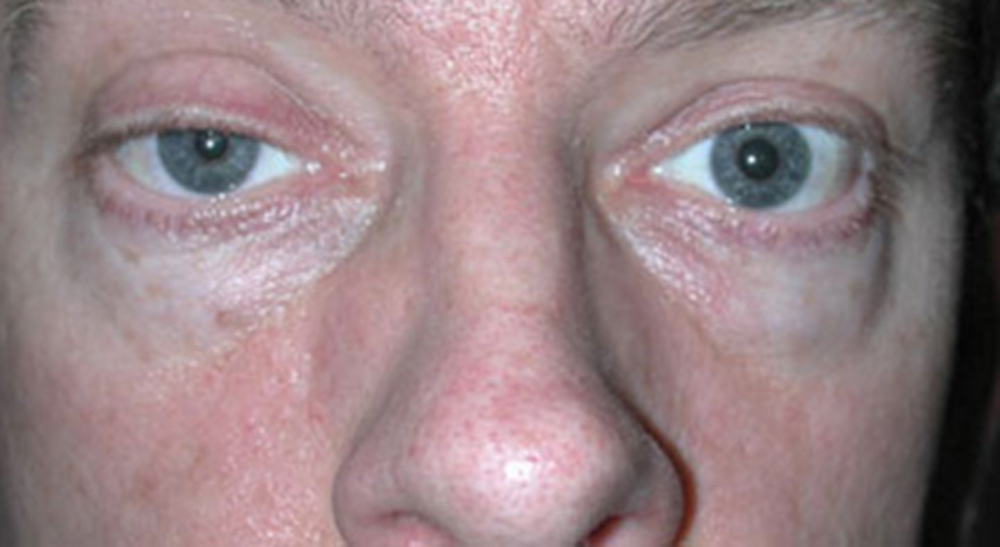 <p>Horner's syndrome (see Horner's Quizlet set)</p>