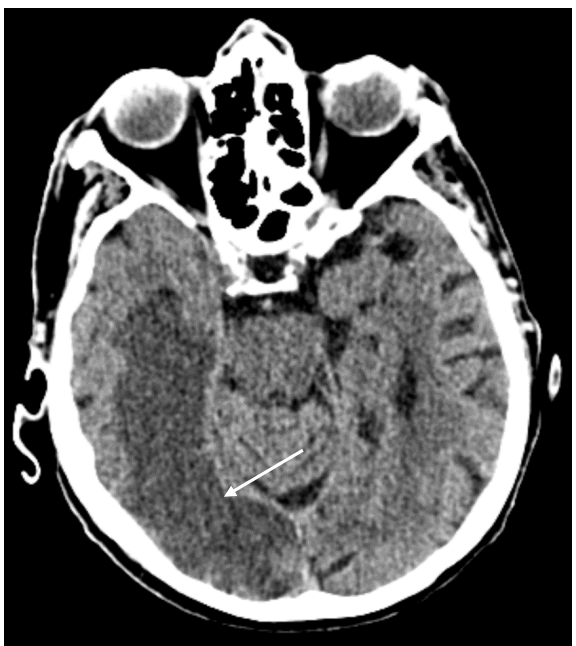 <p>What does this CT image show?</p>