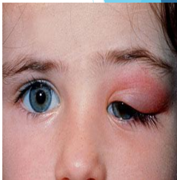 <p>Inflammation of lacrimal gland</p><p>Cause: Infection, conjunctivitis, orbital cellulitis</p><p>Symptom: Inflammation of palpebral part, painful swelling laterally, S-shaped curve of lid</p>