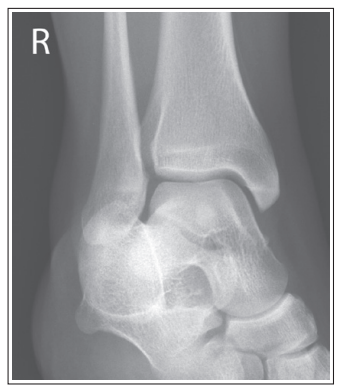 <p>What are the issues with this ankle? </p>