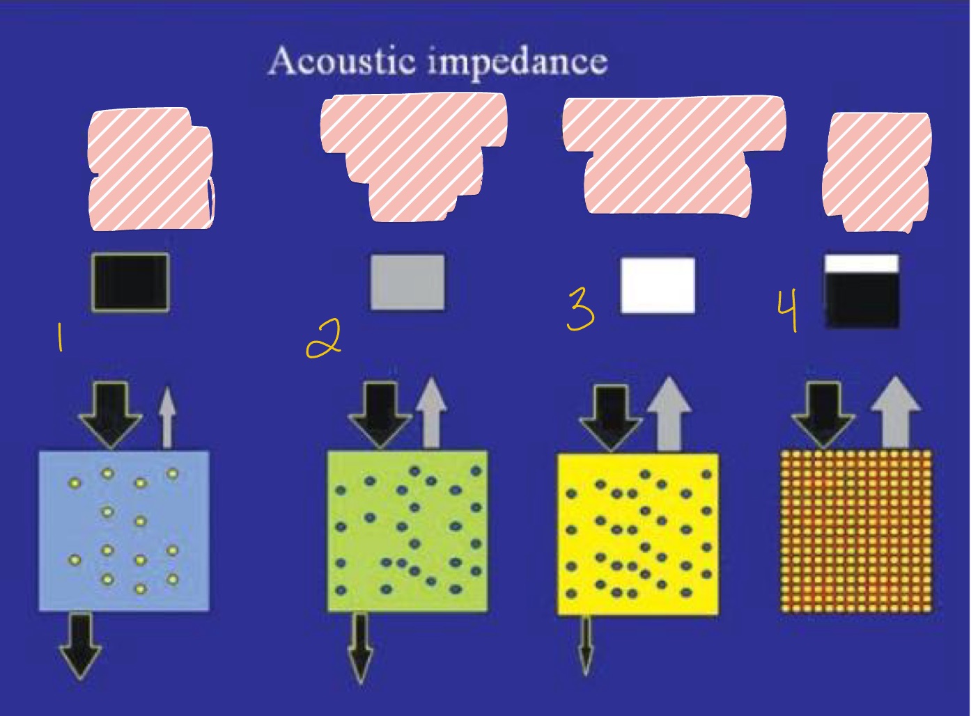 <p>What is seen in #4 with <strong>highest</strong> Acoustic Impedance?</p><ul><li><p>Fibrous Tissue (Diaphragm)</p></li><li><p>Fluid (blood)</p></li><li><p>Solid (Stone)</p></li><li><p>Soft Tissue (liver)</p></li></ul><p></p>