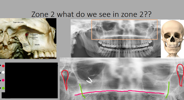 <p>What do we see in Zone 2?</p>