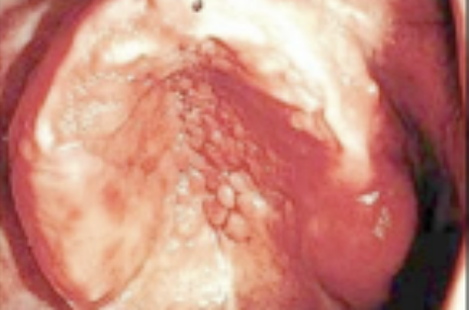 <p>Tot de verruceuze/papillaire afwijkingen worden de afwijkingen gerekend die een uitwas zijn van de mucosale membraan. Deze afwijkingen hebben diverse verschijningsvormen met een lokale exofytische groeipotentie en kunnen variëren van enkele millimeters tot enkele centimeters. De afwijkingen kunnen overal op orale mucosa voorkomen. De oorzaak is een niet goed passende prothese of chronische candidiasis. Aan het begin is het rood en ontstoken, vervolgens oedematische slijmvliezen en tenslotte ontstaan er kenmerkende papillaire beeld. Je kan dit behandelen door de prothese aan te passen of de candidiasis aan te pakken.</p>