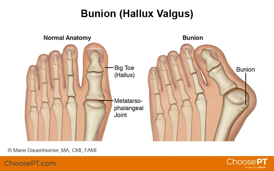 A bony bump that forms on the joint at the base of the big toe. Calcification can occur, widening of metatarsals. Prevented with wedges