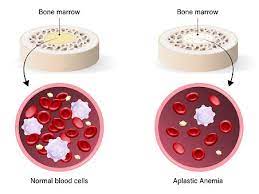 <p>Ex: Aids (worst anemia!). Caused by toxic chemicals, radiation. Damages Bone marrow (without stem cells there will be no blood cells)</p>