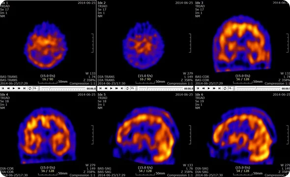 <ul><li><p>do těla zaváděn radionuklid emitující gama záření</p></li><li><p>radionuklid se dokáže vázat ve specifických orgánech nebo být z těla rychle vyloučen</p></li><li><p>vyzařované fotony jsou z různých směrů detekovány scintilačními detektory => příčný řez</p><ul><li><p>struktury viditelné na řezu = místa emitující záření</p></li></ul></li></ul><p></p>
