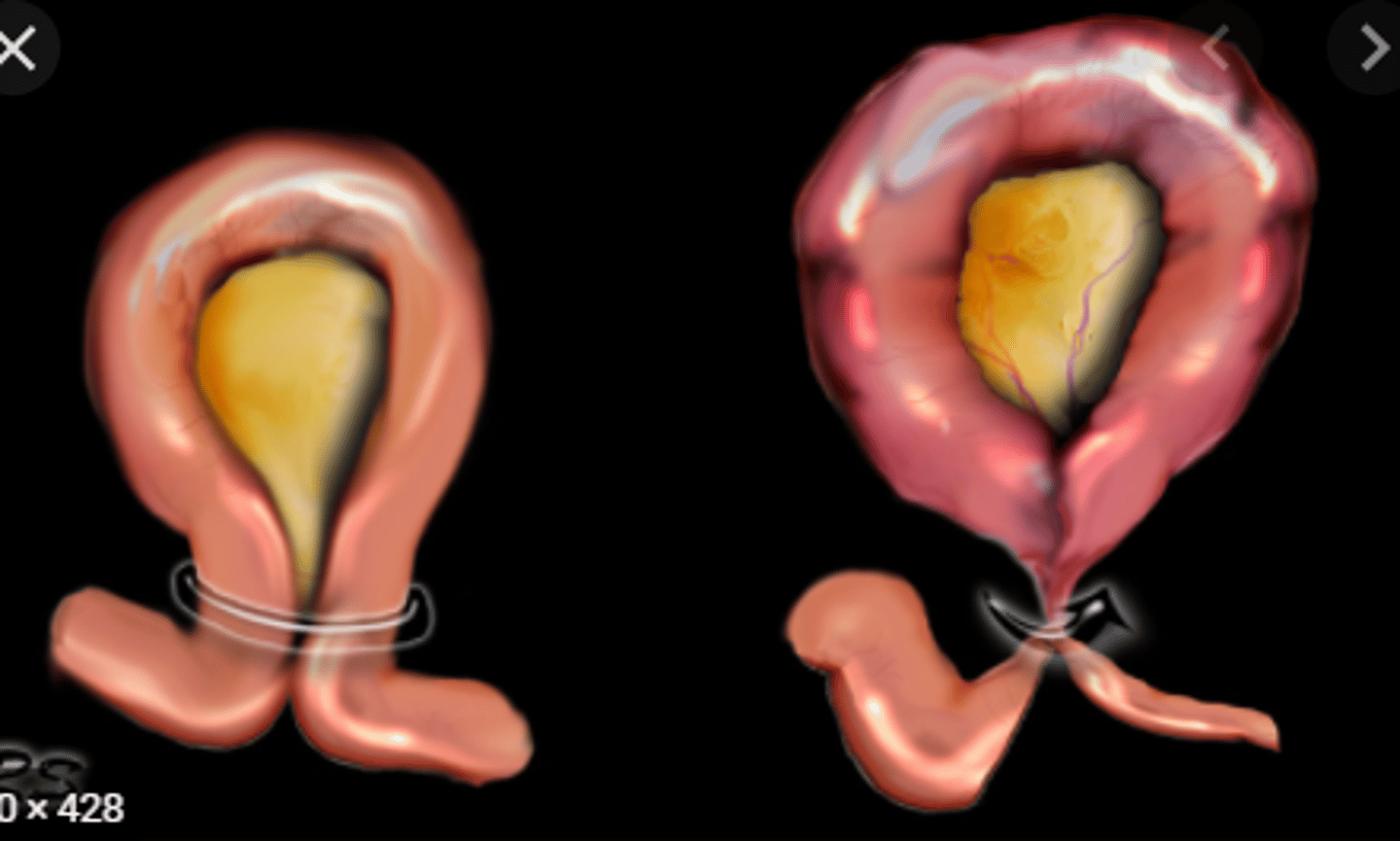 <p>Free air</p><p>Peritonitis</p><p>Closed Loop Obstruction (NG will not help usually)</p><p>Failure to resolve 2-5 days</p>