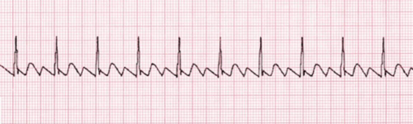 <p>Atrial flutter</p><p>In atrial flutter, atrial contraction occurs at such a rapid rate that discrete P waves separated by a flat baseline cannot be seen on the strip. Instead, the baseline continually rises and falls, producing the “flutter” waves. In leads II and III, the flutter waves may be quite prominent, creating a “sawtooth” pattern. Because of the volume of atrial impulses, the AV node allows only some of the impulses to pass through to the ventricles. In atrial flutter, a 2:1 ratio is the most common (i.e., for every two flutter waves, only one impulse passes through the AV node to generate a QRS complex). Ratios of 3:1 and 4:1 are also frequently seen.</p>