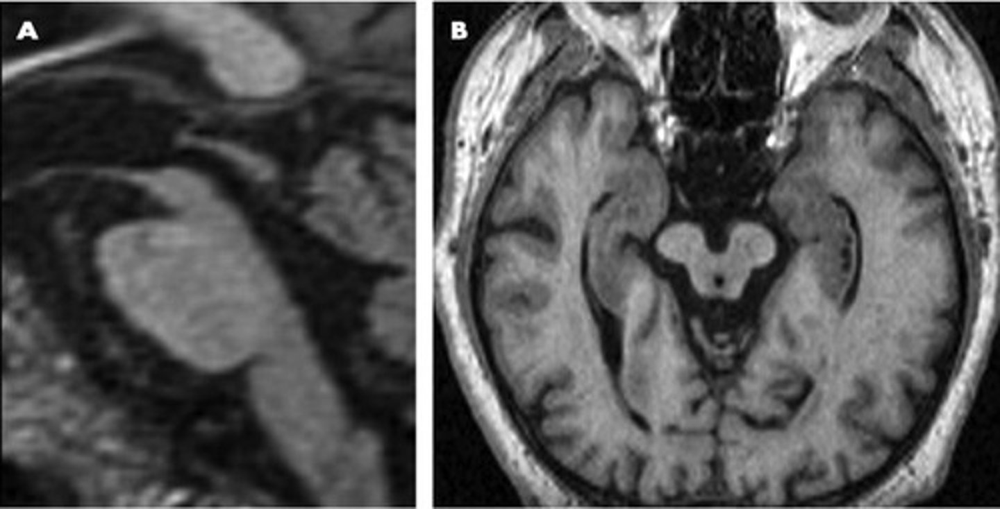 <p>any disease that is associated with abnormal accumulations of the protein Tau, forming neurofibrillary tangles that impair the normal function of neurons</p>