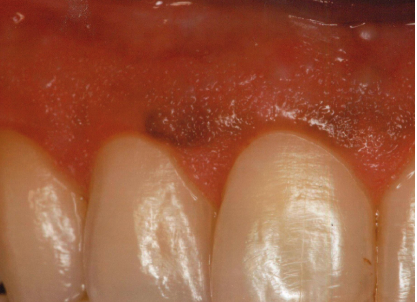 <p>post-inflammatory hypermelanosis (Smoker’s melanosis) lesions are more <strong>diffused&nbsp;</strong></p>