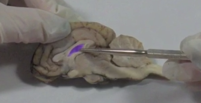 <p>Lateral ventricle </p>