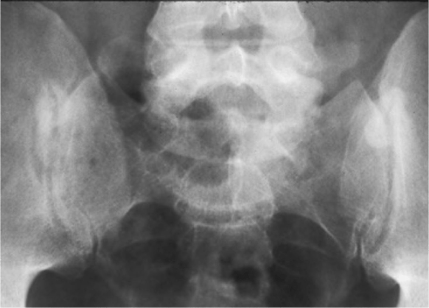 <p>ID complication of degenerative lumbar spine disease</p>