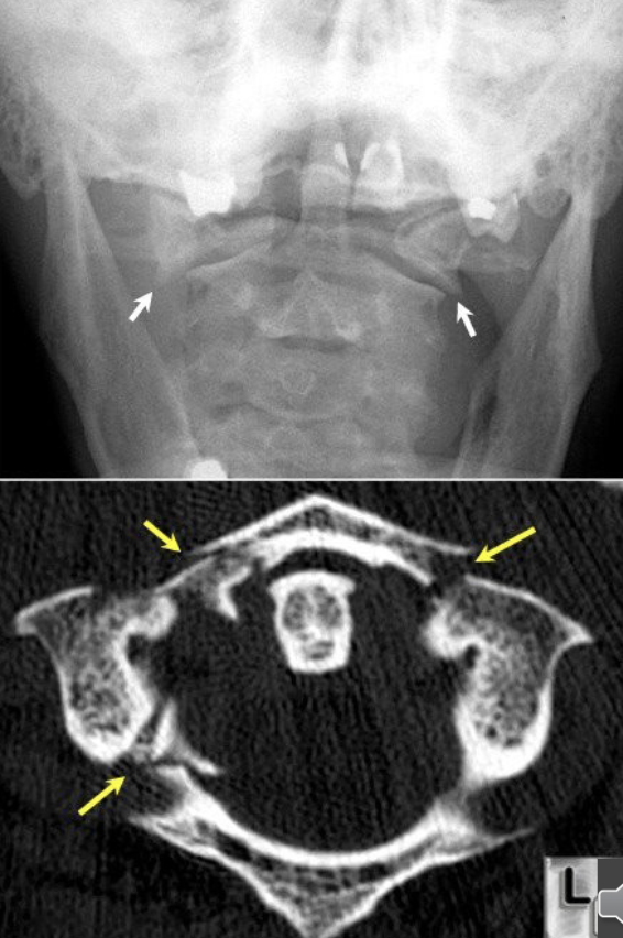 <p>Name this fracture</p>
