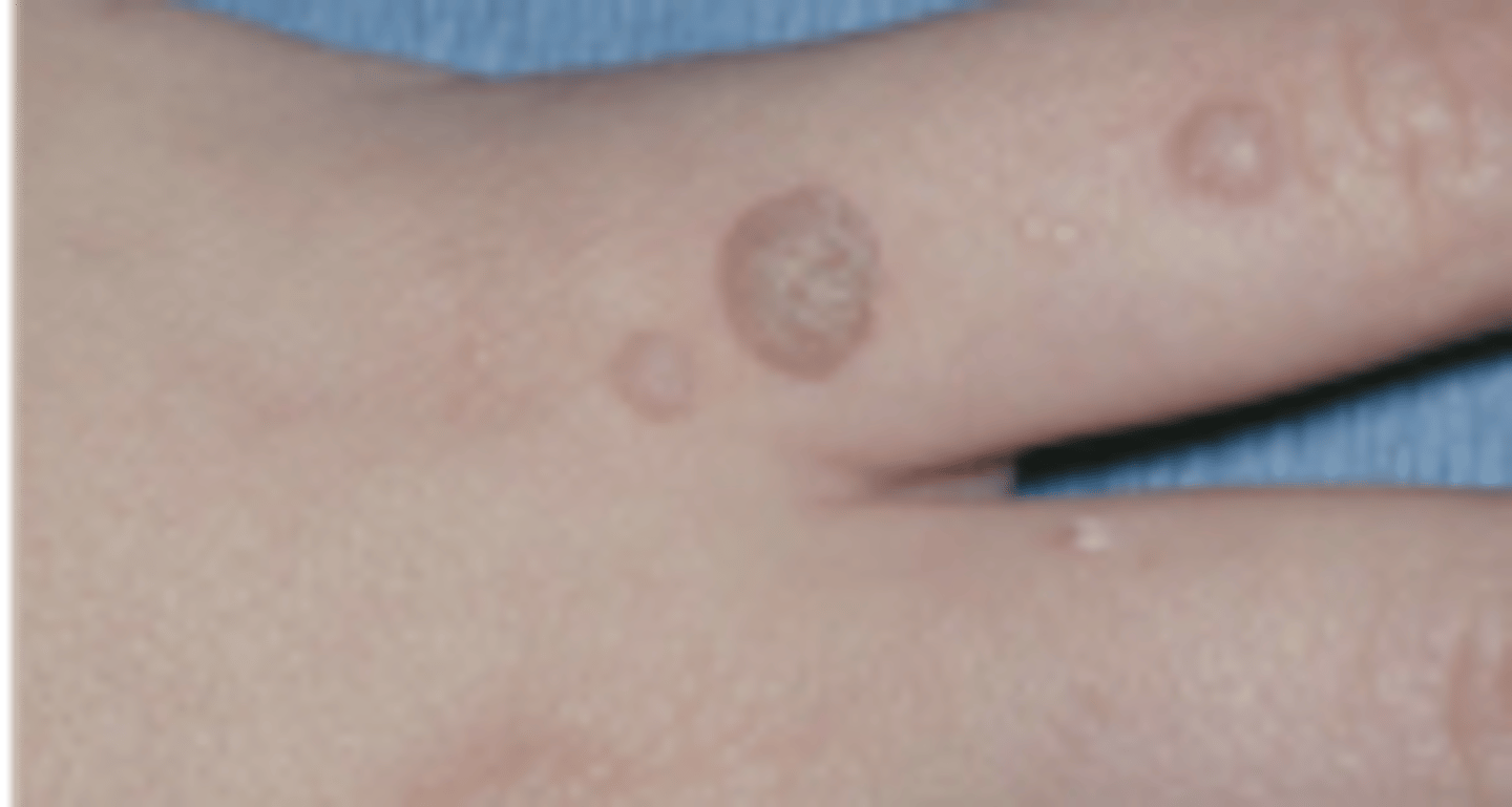 <p>Hint: focal, benign, HPV-induced proliferation of stratified squamous epithelium</p>