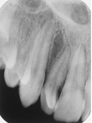 <p>Study the lateral incisor. What feature(s) can you not regarding this tooth?</p><p> </p><p>accessory lingual cusp</p><p> </p><p>dens in dente</p><p> </p><p>dilacerated crown</p><p> </p><p>peg lateral</p><p> </p><p>all of the above</p>