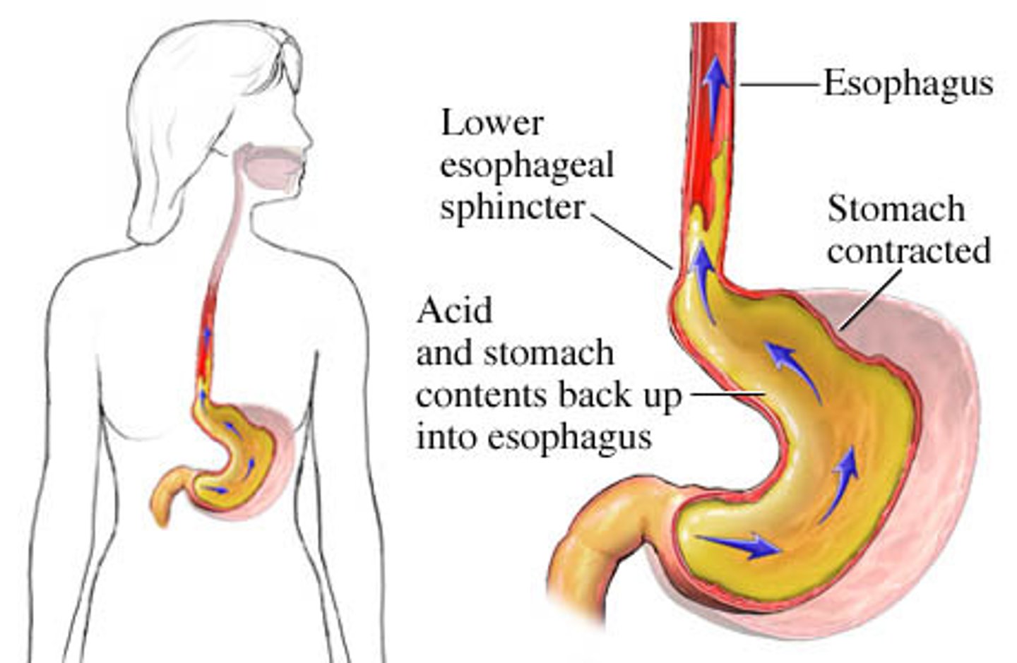 <p>Incompetent lower esophageal sphincter allows gastric contents to move backward, causing esophageal tissue injury over time. Occurs in 20-30% of adults and some newborns or infants</p><p>Sxs: Heartburn, belching, chest pain, coughing, esophagitis, hematemesis. If untreated, may develop esophageal strictures, esopaghitis, aspiration pneumonia, asthma, and esophageal adenocarcinoma</p><p>PT Rehab Considerations: Avoid certain exercises, recumbency will induce symptoms. Head/neck discomfort secondary to perception of lump in throat and subsequent compensation. Tight clothing, exercise, and constipation may precipitate it. Chronic bronchitis, asthma, and pulmonary fibrosis may present with GERD.</p><p>Have them sleep in left sidelying with pillows elevated (lower esophagus bends to left, so reflux is minimized)</p>