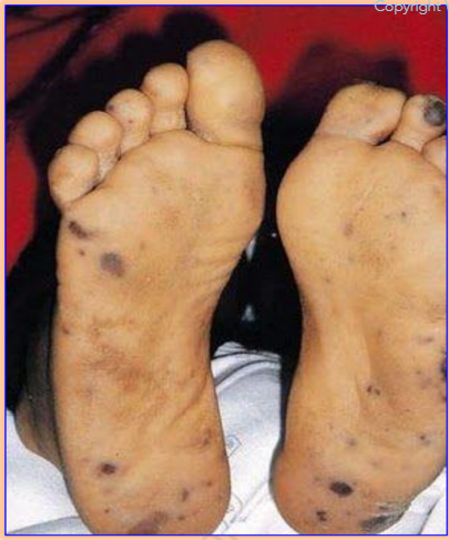 <p>man presents with fever, confusion and petechiae. what is shown in the picture and most likely the diagnosis? how to diagnose?</p>