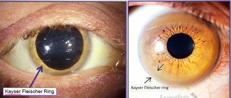 <ul><li><p>later manifestation of Wilson’s disease </p></li><li><p>ring at the periphery of the cornea </p></li></ul><p></p>
