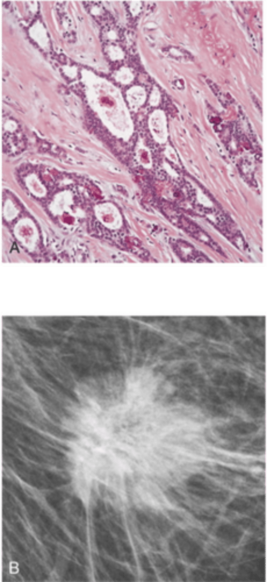 <p>Define Type of Breast Cancer:</p><p>MC Morphologic type of invasive carcinoma in breast - classically forms duct-like structures (80% of cases)</p><p>-Path:</p><p>&gt; Atypical ductal hyperplasia -&gt; DCIS</p><p>-Dx: </p><p>&gt; Histo</p><p>&gt;&gt; A/w calcifications</p><p>&gt;&gt; Infiltrating well-differentiated tubules to sheets of pleomorphic (poorly differentiated) tumor cells in desmoplastic stroma; no myoepithelial cell layer</p><p>&gt; Mamm: Desmoplastic response --&gt; Firm Mass &amp; Density</p>
