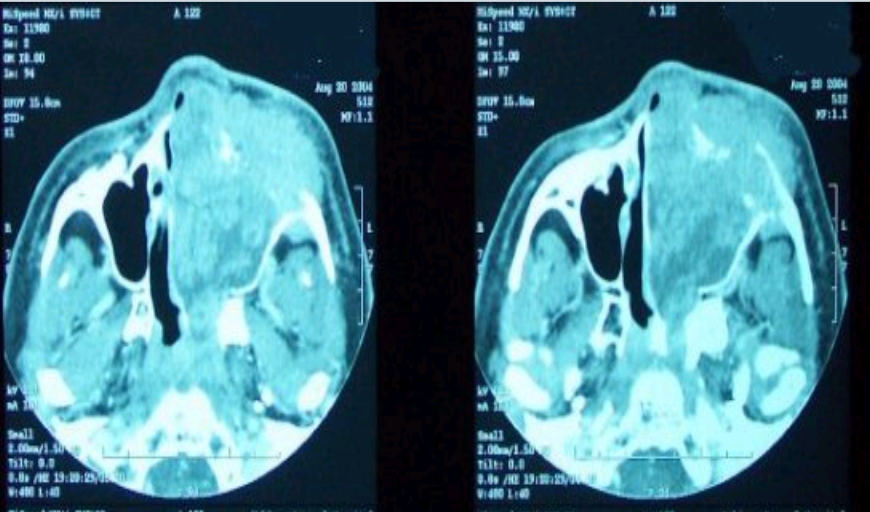 <p>what would be the diagnosis from this scan</p>