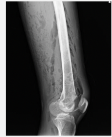 <p>35 y/o patient presents to the ED for leg pain. He states that he was out surfing yesterday and caught his leg on his board. Vitals are as follows, 90/63, 134 bpm, 103.5 temp. On physical exam you note blackish blisters on the skin that when pressed feel like rice krispies - when you do this your patient screams. Labs reveal leukocytosis and AKI. CT shows thickening of the fascia as well as bubbles along the fascial planes. What is your game plan?</p>