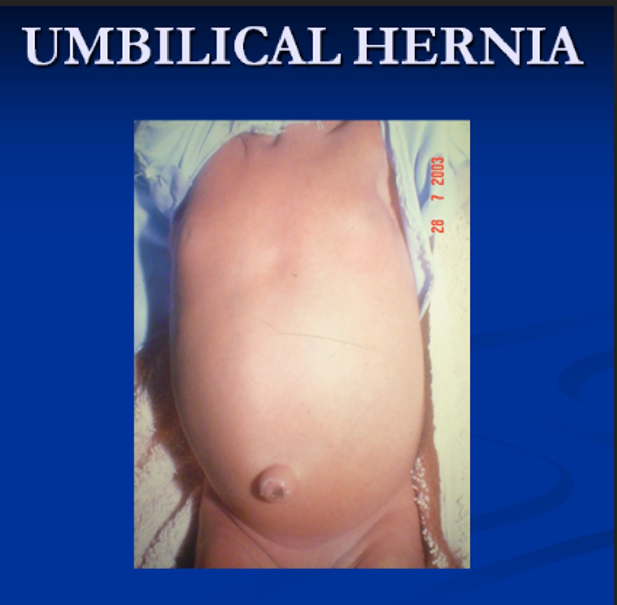 <p>C</p><p>The umbilicus is normally midline and inverted with no signs of discoloration. With an umbilical hernia, the mass is enlarged and everted. The other responses are incorrect</p>