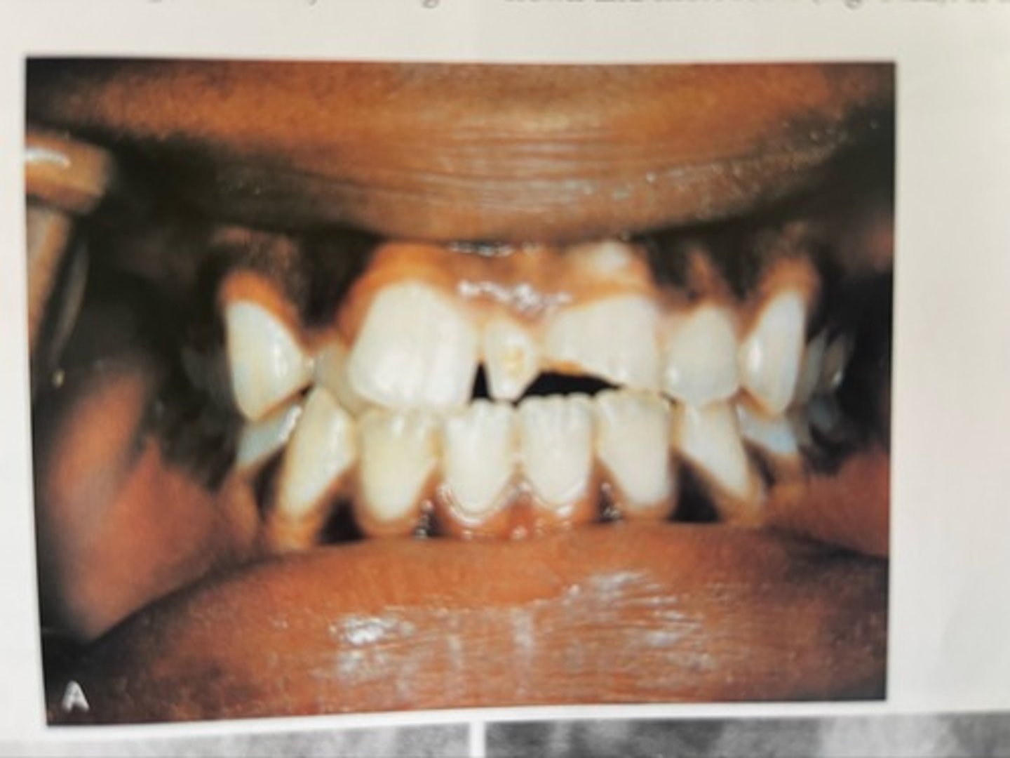 <p>mesiodens.</p><p>A mesiodens is a supernumerary tooth located between the maxillary central incisors at the midline.</p>