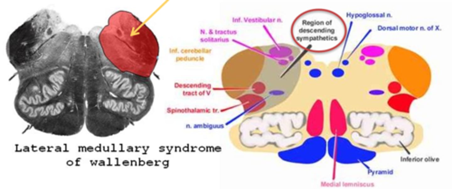 <p>aka lateral medullary syndrome = issue with the inferior cerebellar peduncle (medial and inf vestibular nuclei) </p>