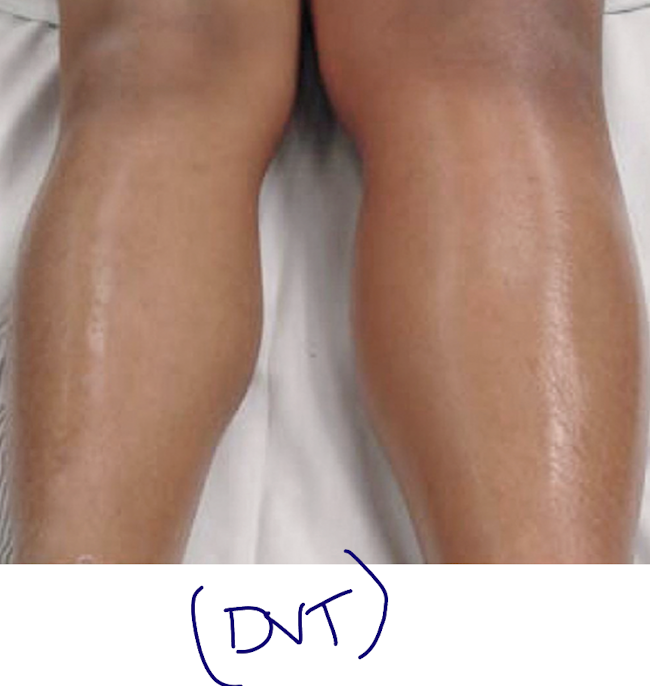 <ul><li><p>unilateral (no bilateral) leg pain</p></li><li><p>calf tenderness</p></li><li><p>swelling</p></li><li><p>redness</p></li><li><p>warmth</p></li></ul><p></p>