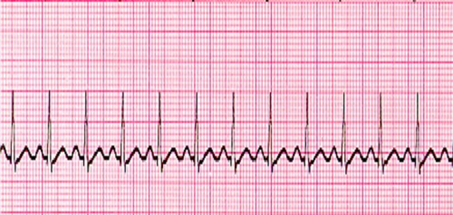 <p>What does the ECG show?</p>