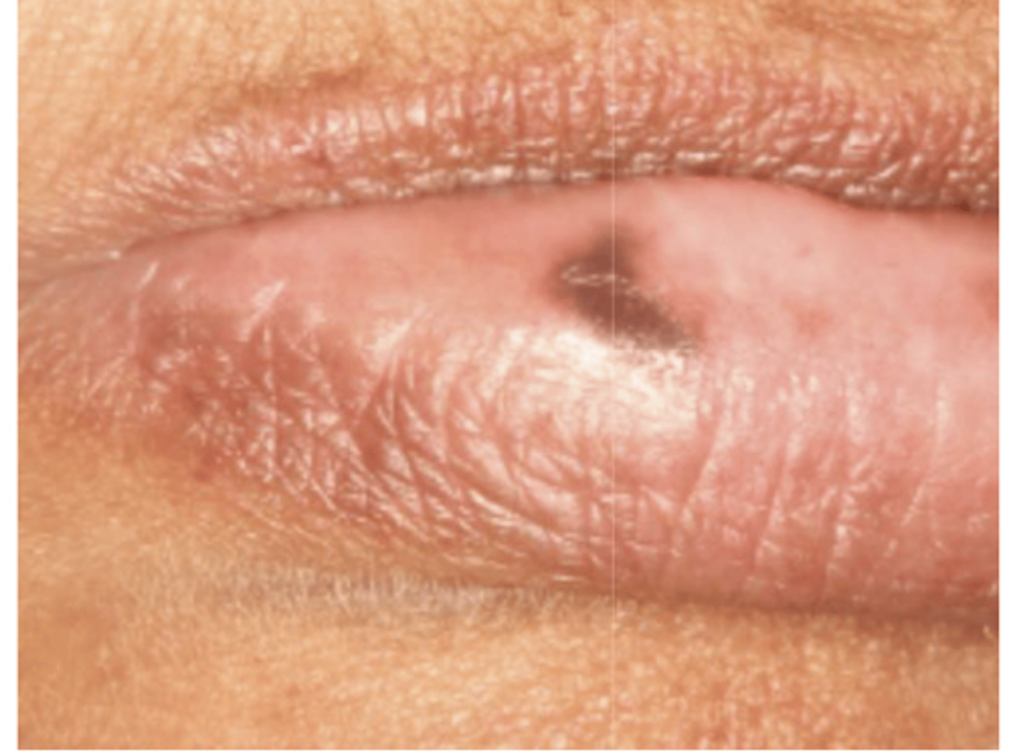 <p>What type of pigmented lesion?</p>