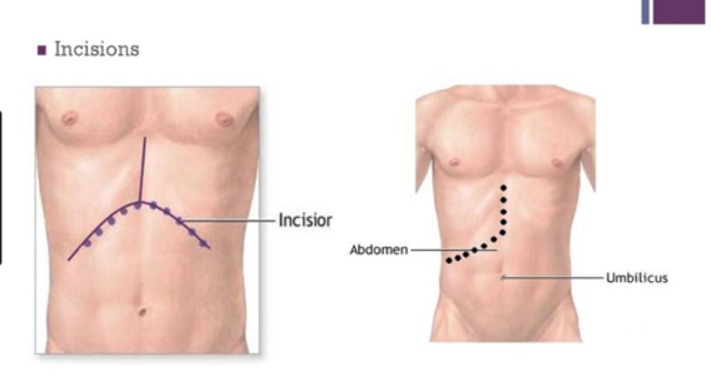 <p>Chevron or Mercedes Benz incision in the upper abdomen</p>