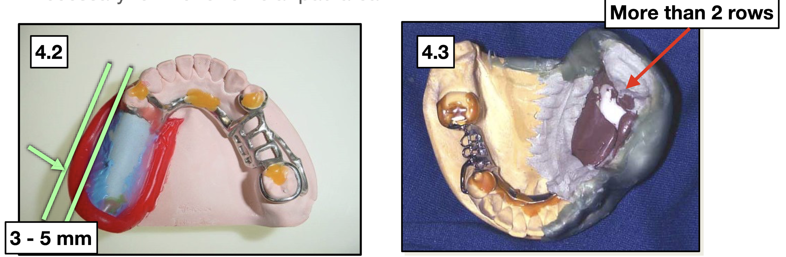 <ol><li><p>wax should be 3mm above the impression border </p></li><li><p>roping wax should be 5 mm wide for land area</p></li><li><p>more than 2 rows of roping wax are necessary for retromolar pad area</p></li></ol><p></p>