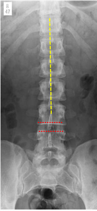 <p><span style="font-family: &quot;Wingdings 2&quot;;"></span>Cortical outlines of the vertebrae should be intact and trabecular pattern comparable between each of the vertebrae</p><p><span style="font-family: &quot;Wingdings 2&quot;;"></span>Size of vertebral bodies increases progressively from L1-L5</p><p><span style="font-family: &quot;Wingdings 2&quot;;"></span>Interspinous distance should be approximately equal throughout the lumbar spine indicating no widening or loss of joint space</p><p><span style="font-family: &quot;Wingdings 2&quot;;"></span>Spinous processes should be centralised throughout the lumbar spine indicating no disruption of the vertebral alignment.</p><p><span style="font-family: &quot;Wingdings 2&quot;;"></span>Inter- pedicular distance should be virtually equal throughout the lumbar spine indicating no disruption of the vertebral bodies.</p><p><span style="font-family: &quot;Wingdings 2&quot;;"></span>Pedicles and transverse processes should be symmetrical throughout lumbar spine indicating no disruption of the vertebral alignment.</p><p><span style="font-family: &quot;Wingdings 2&quot;;"></span>No evidence of abnormal soft tissue outlines, which would&nbsp; indicate para-vertebral swelling.</p><p></p>