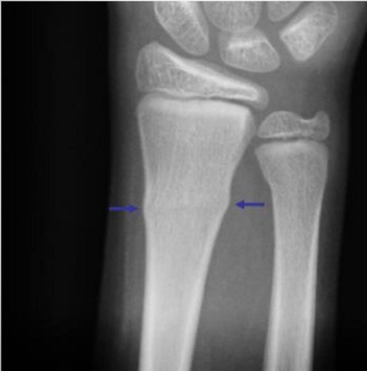 <p>Impacted fracture with bulging of periosteum</p>