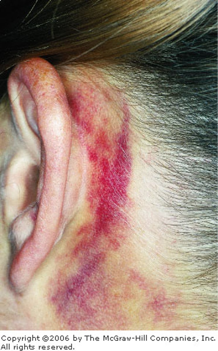 <p>skull injury- A bruise behind the ear of a trauma patient is called Battle sign, and is an important sign of a skull injury.</p>