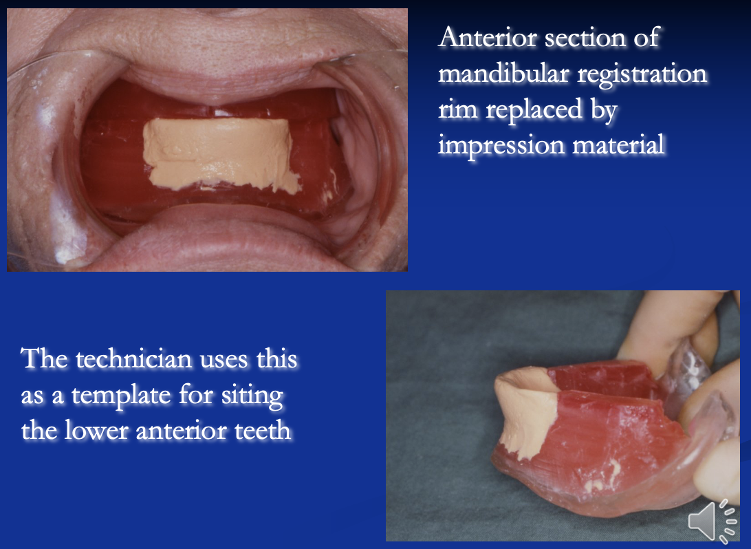 <ul><li><p>get patient to move their lip and tongue </p></li><li><p>this moulds the impression material into a shape where you can set the anteriors in the best position</p></li></ul><p></p>