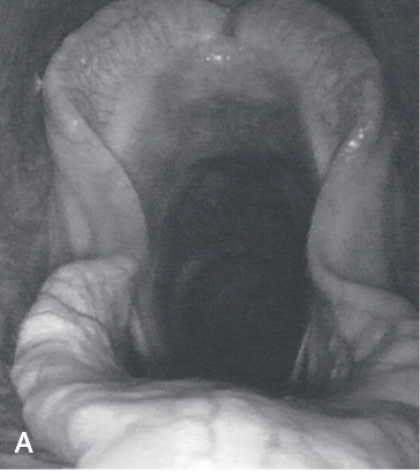 <ul><li><p><span>Occurs during maximal exertion and causes dynamic partial upper respiratory tract obstruction</span></p></li><li><p><span>Contralateral aryepiglottic collapse is seen in horses with laryngeal hemiplegia</span></p></li><li><p><span>Mild to moderate AE fold collapse can also be seen in horses with DDSP</span></p></li><li><p><span>Diagnosis requires videoendoscopic examination during high-speed exercise</span></p></li><li><p><span>In a study of affected horses 80% were racing Thoroughbreds, 13% were racing Standardbreds, and 7% were racing Arabians</span></p></li><li><p><span>Abnormal respiratory noise and exercise intolerance were the most common clinical manifestations</span></p></li><li><p><span>Condition is almost always bilateral, but unilateral involvement if present, has been reported to be right-sided</span></p></li></ul>