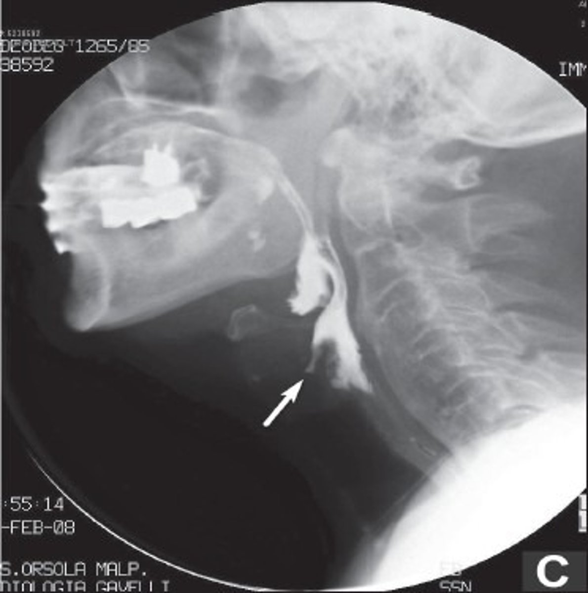 <p>Same approach used to look at velopharyngeal mechanism</p><p>Person swallows substances mixed with barium sulphate</p><p>- Contrast material that allows bolus to be tracked visually as it travels through oral, pharyngeal, and esophageal regions</p>