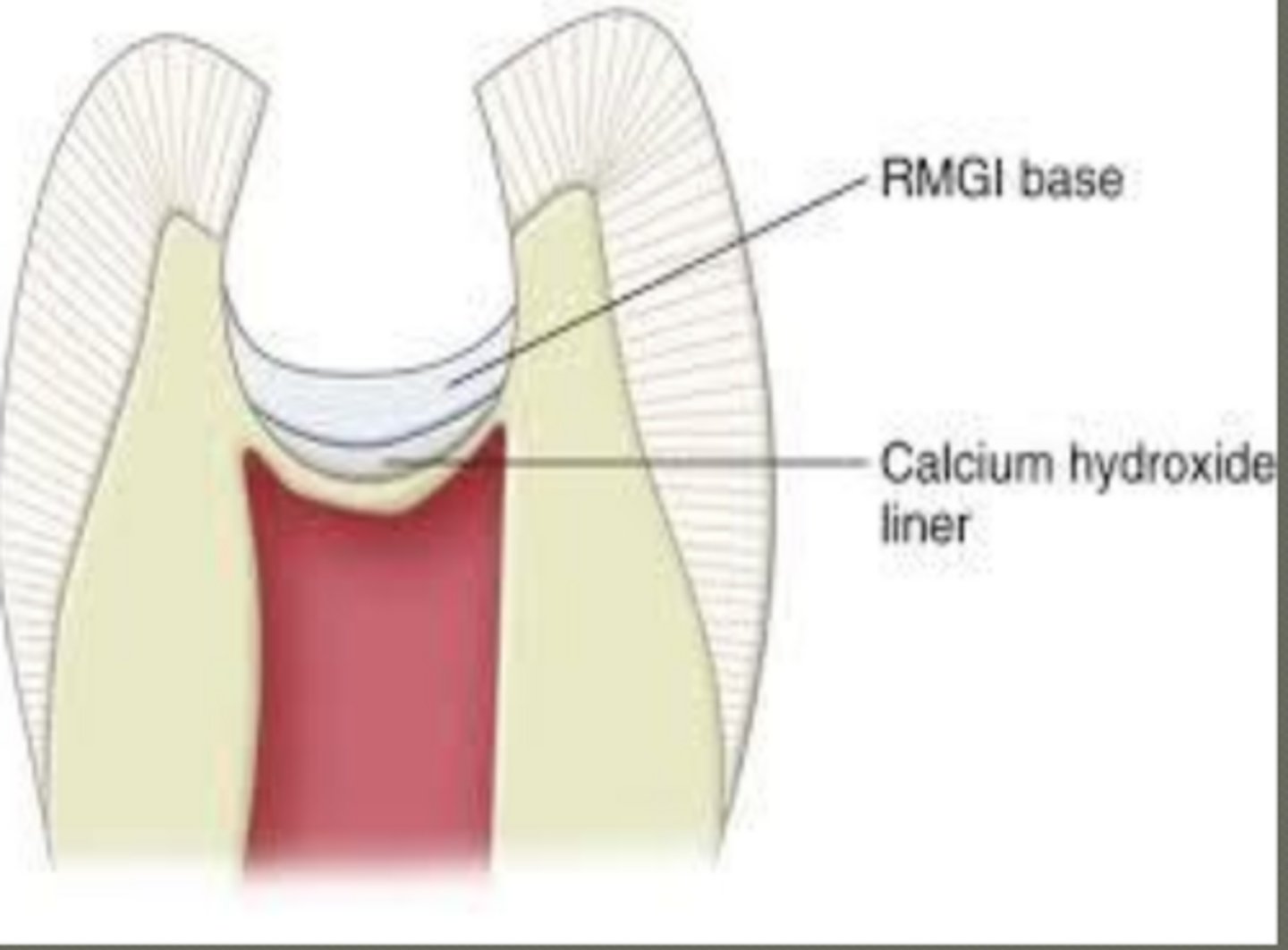<p>base (Not secondary liner for amalgam)</p><p>- thermal protection</p><p>base or secondary liner for composite</p><p>- done prior to etching and bonding</p>