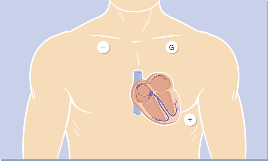 <ol><li><p>V1 → RIGHT Sternum </p></li><li><p>V2 → LEFT Sternum</p></li><li><p>V4 → LEFT under Nipple </p></li><li><p>V3 → BETWEEN V2 &amp; V4</p></li><li><p>V6 → LEFT under Axillary </p></li><li><p>V5 → BETWEEN V4 &amp;.V6</p></li><li><p></p></li></ol><p></p>