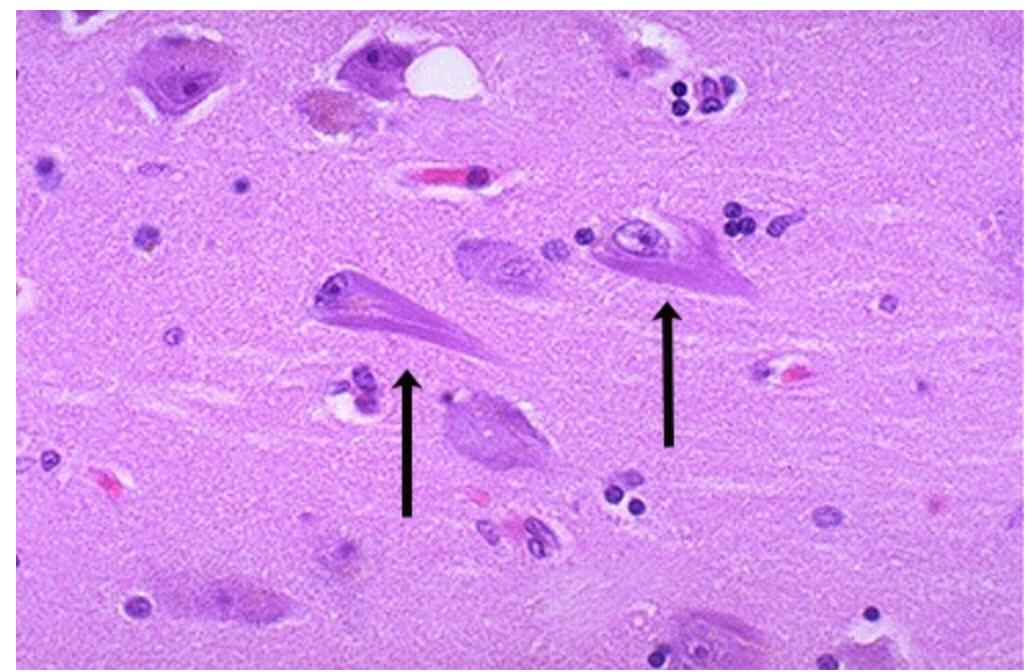 <p>Histological view of neurons in a patient with Alzheimer’s disease. Identify the manifestation pointed by the black arrows.</p>